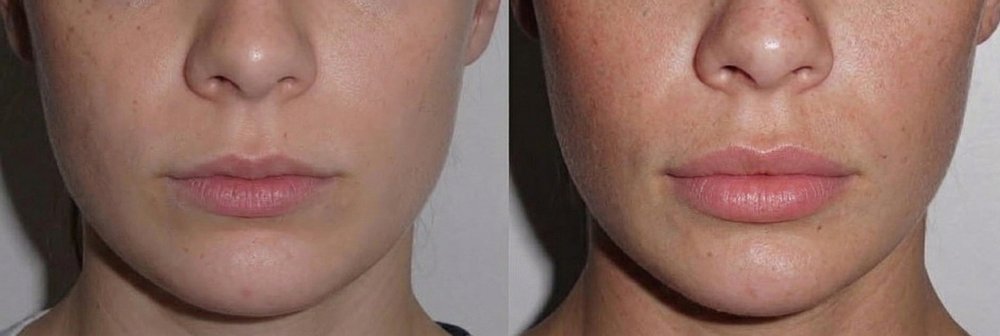 Lip filler, before and after